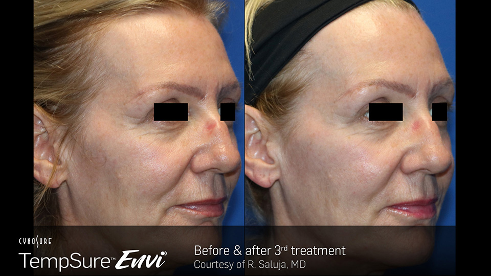 Before and after photos
