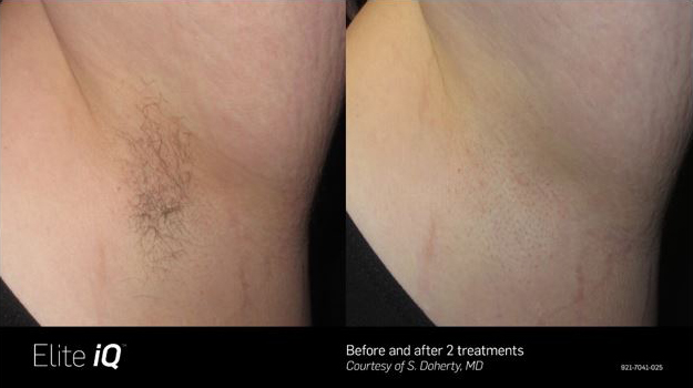 Before & After