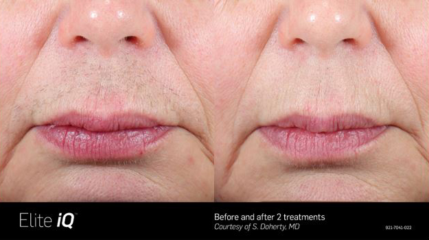 Before & After