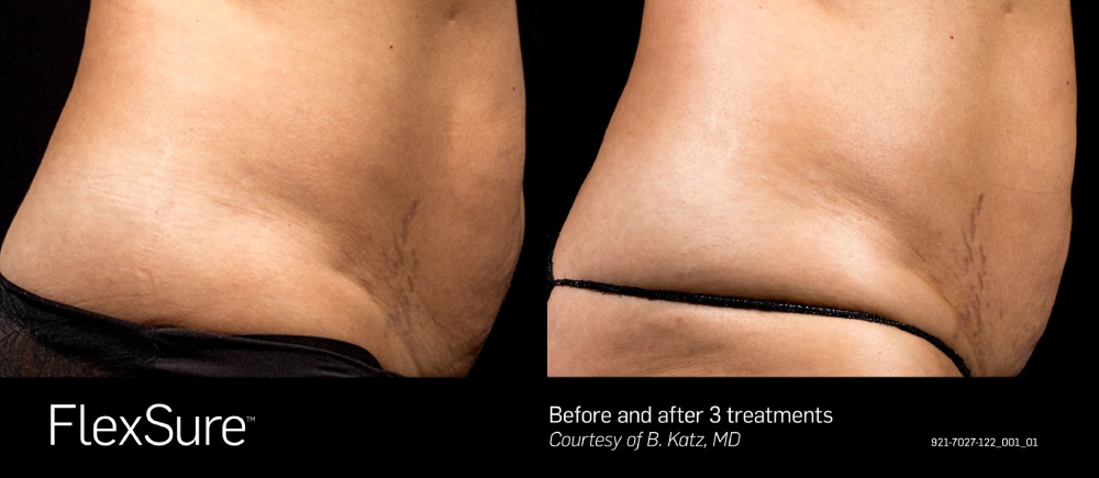 FlexSure before & after