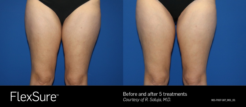 FlexSure before & after