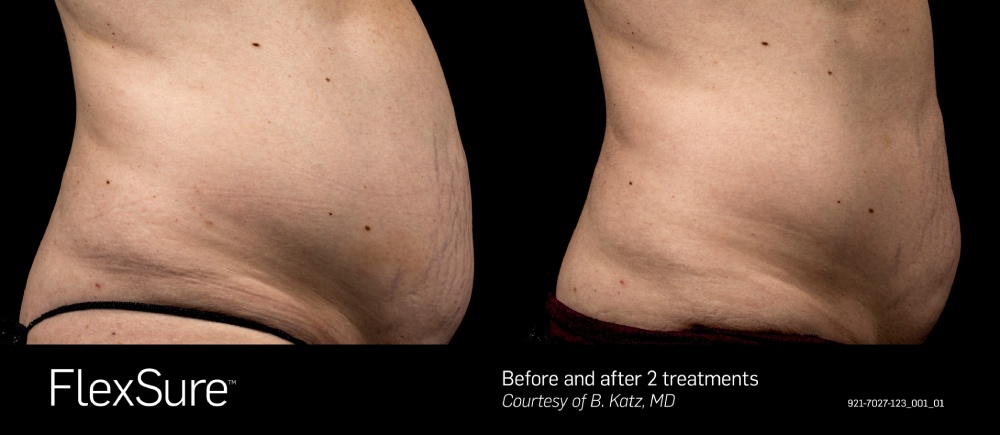 FlexSure before & after