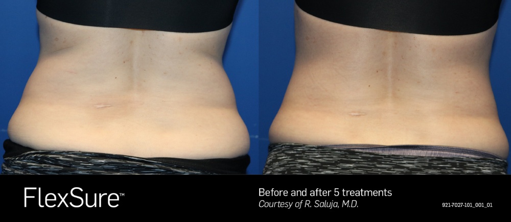 FlexSure before & after