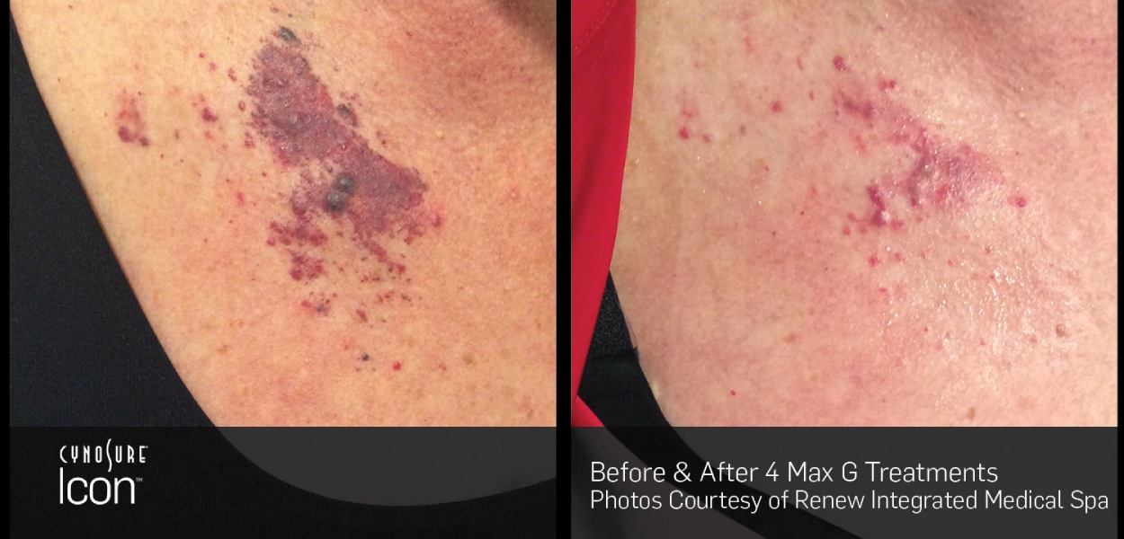 BA_SculpSure_Renew_8.23.17 (2)