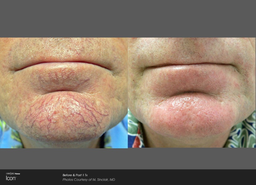Skin-Revitalization-Before-&-After-Photo-3