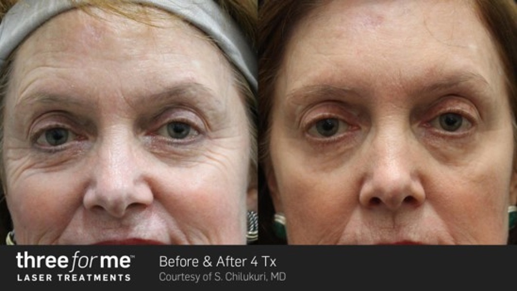 ThreeForMe-Before-&-After---6