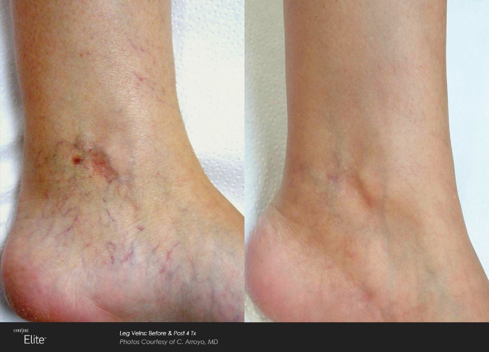 Before & after