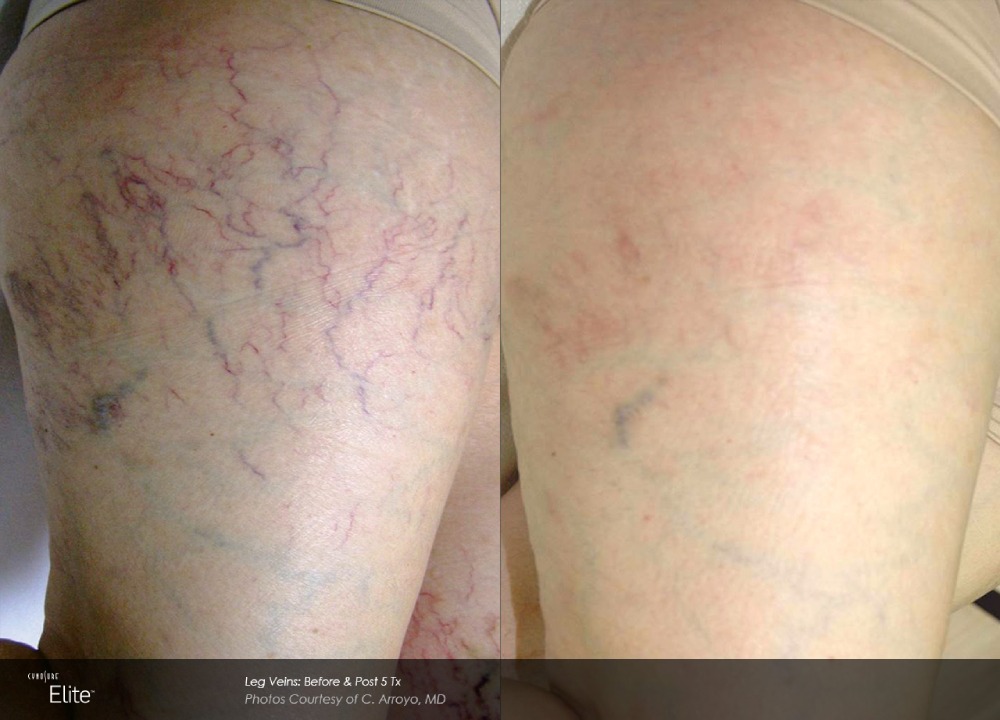 Before & after
