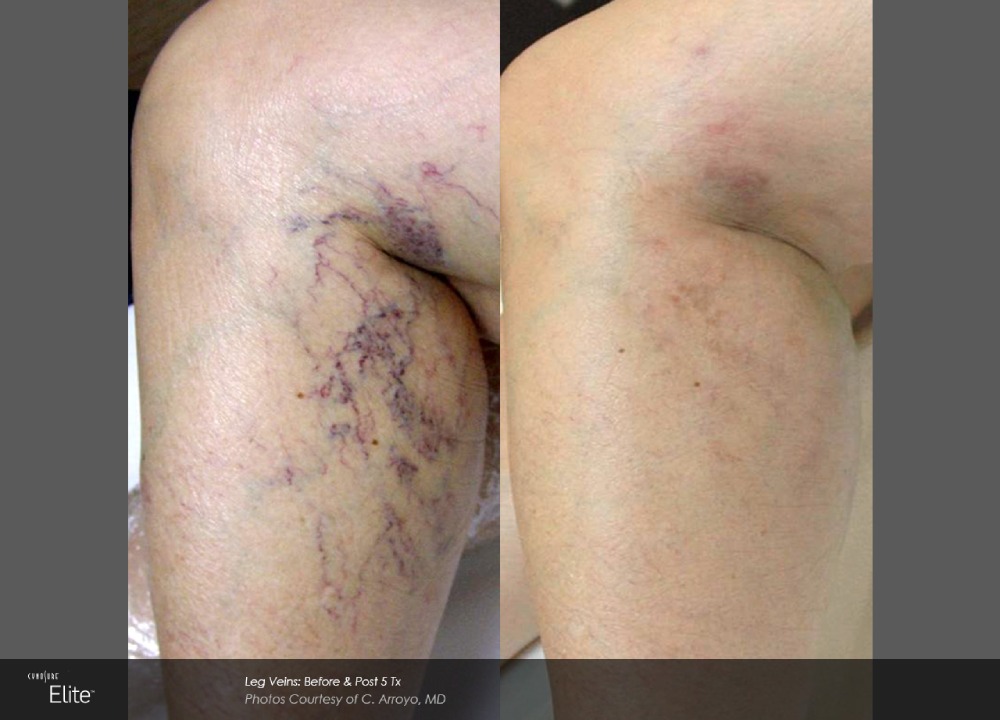 Before & after
